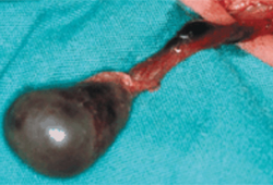 Testicular torsion images