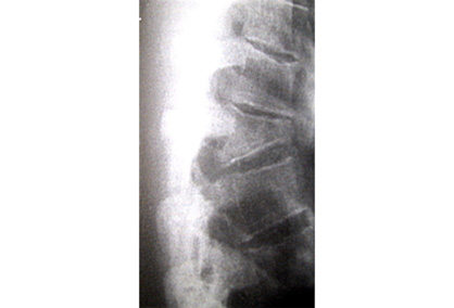 Osteoporotic spinal compression fractures images
