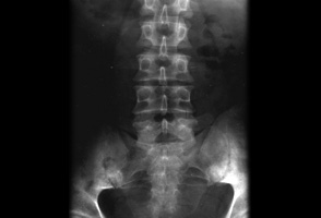 Axial spondyloarthritis images