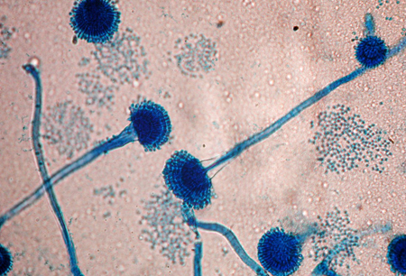 Aspergilosis images