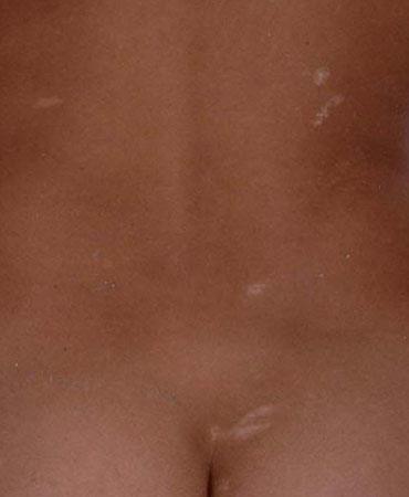 Infantile spasms syndrome images