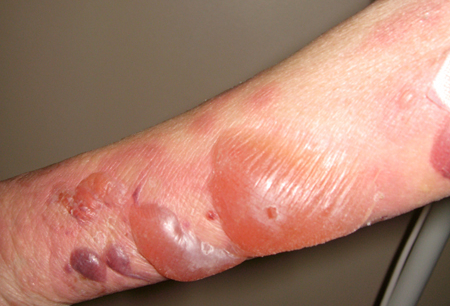 Evaluation of vesicular-bullous rash images