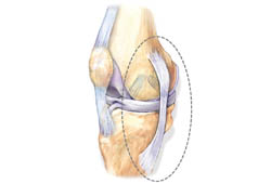 Medial collateral ligament injury images
