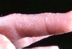 Dyshidrotic dermatitis images